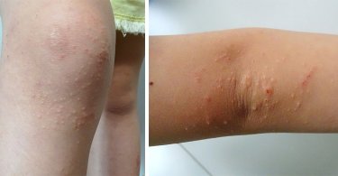 一～六歲要當心！孩子手肘膝蓋突然長滿丘疹