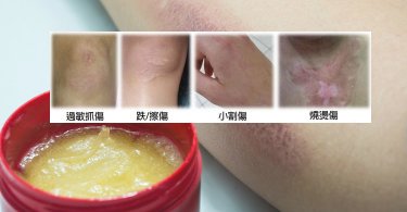 單一方向塗抹！藥師詳解矽膠除疤凝膠使用與挑選