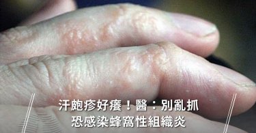 汗皰疹,泡疹,濕疹藥膏,汗皰疹藥膏,疹子,濕疹照片,蜂窩性組織炎,蜂窩性組織炎症狀,